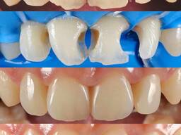 Художественная реставрация зубов