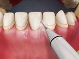 Лечение дёсен профессиональная чистка зубов - photo 2