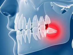 Удаление зуба мудрости